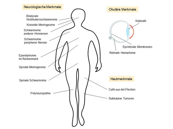 Klinische Merkmale NF2